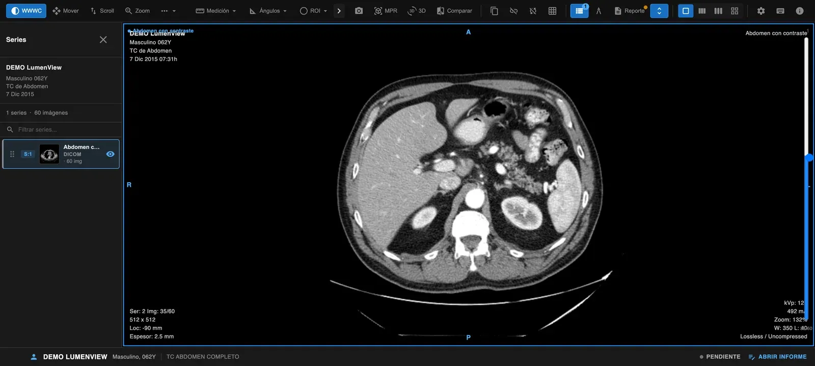 Visor de LumenView con una tomografía de abdomen de demostración, herramientas de medición, MPR y 3D.